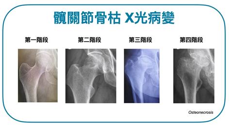 為什麼會骨枯|髖關節骨枯：成因與治療